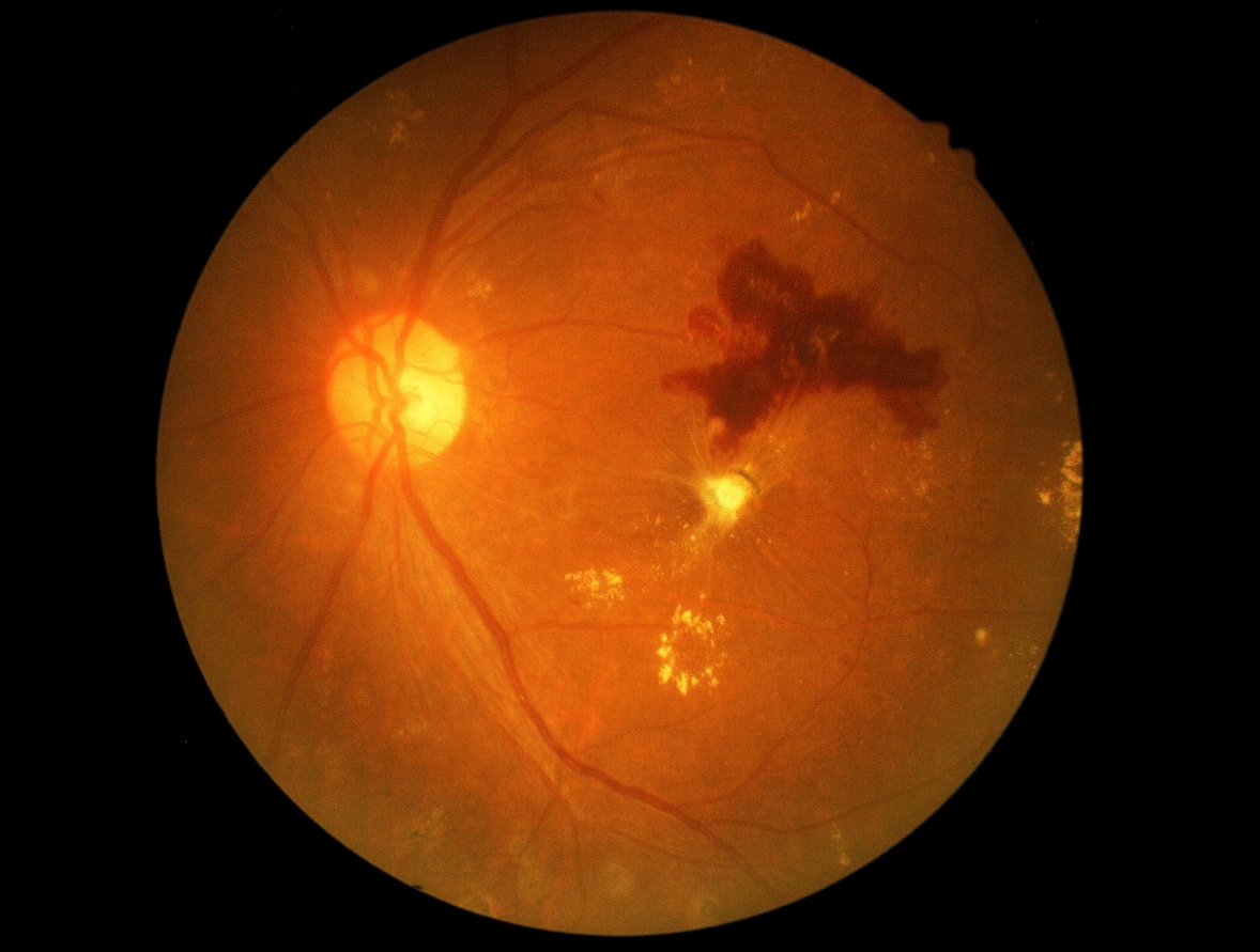 Photo of diabetic retinopathy