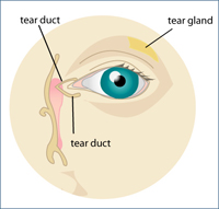 Diagram of dry eye