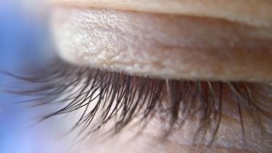 eye lid benaim eye