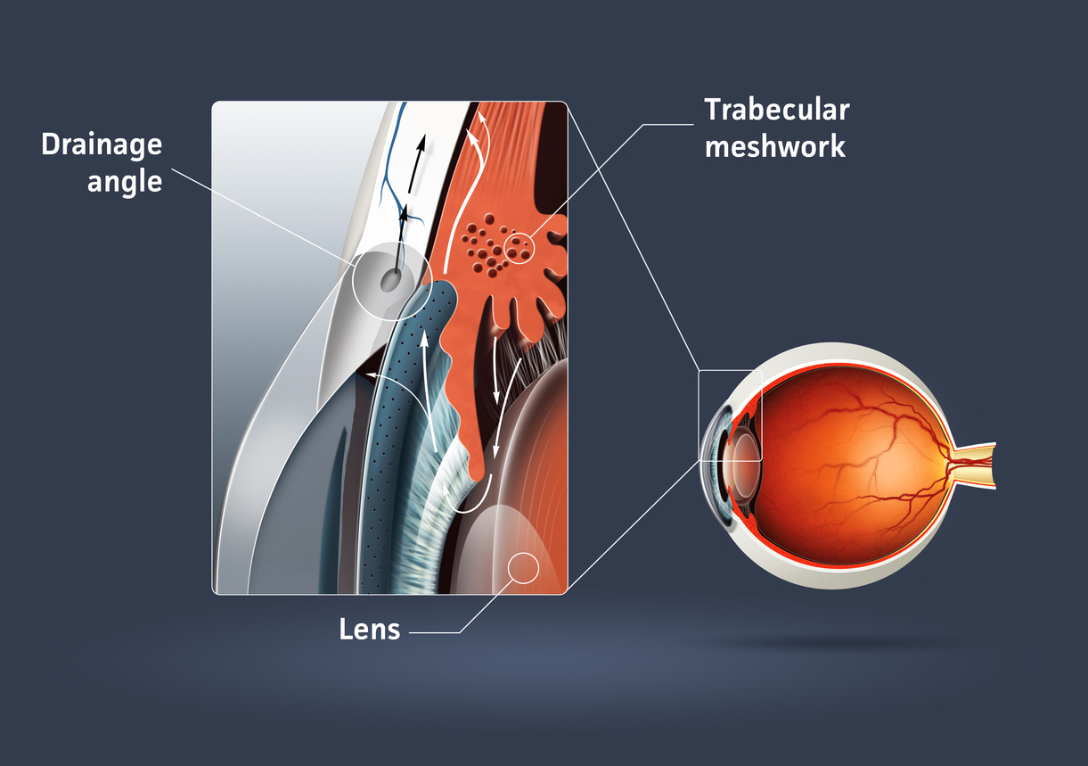 Glaucoma diagram