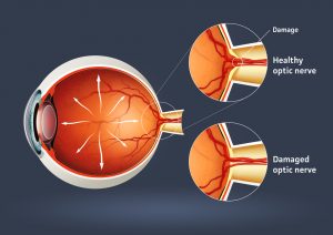 An animation of retinal detachment
