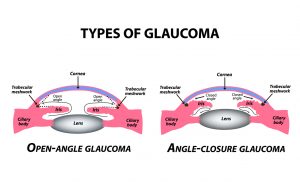 Types of glaucoma. Open-angle and angle-closure glaucoma. The anatomical structure of the eye. Infographics. Vector illustration on isolated background.