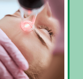 CO2 Laser Peal treatment