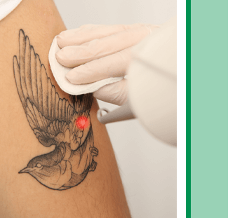 LASER tattoo removal treatments