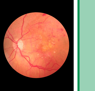 Retina Conditions medical photo