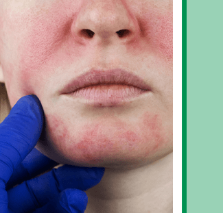 non-invasive Intense Pulsed Light (IPL) Rosacea treatment