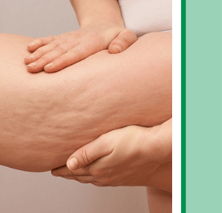 cellulite reduction treatment