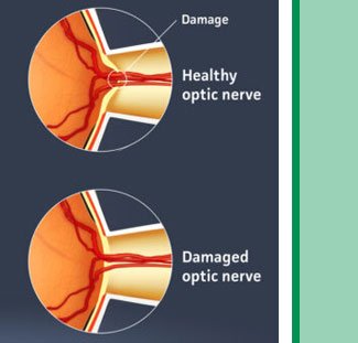 detached-retina-detachment-medical-illustration-sm