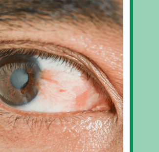 Pterygium Disease diagnosis and treatment