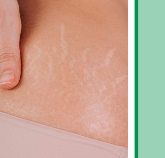 laser stretchmark removal treatment