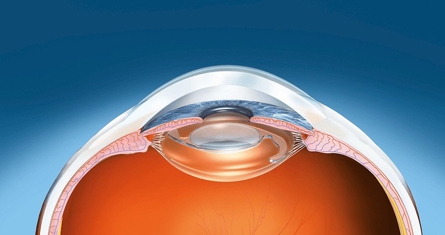 Medical diagram of an eye showing the lens, cornea, and a tortic lens implant